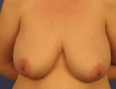 Patient # 27515 Before Photo # 1